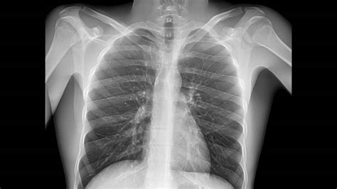 asthma on xray|Asthma Imaging and Diagnosis: Practice Essentials, .